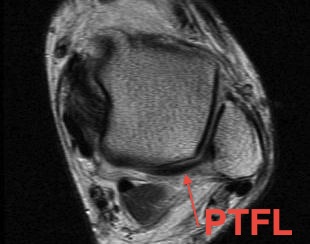 MRI Ankle Intact PTFL